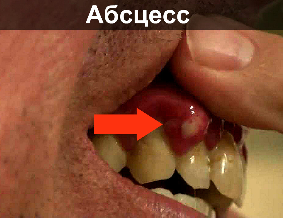 Если головная боль отдает в зубы. Может ли после удаления зуба болеть голова, отдавать в висок, ухо или шею