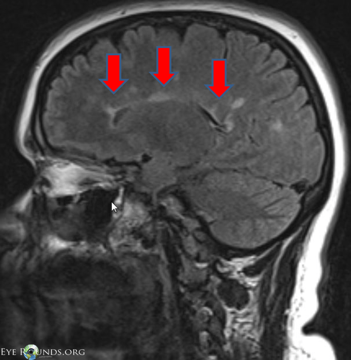 The blind spot is a part of the retina where there are no photoreceptors. Optic neuritis: from one medical student to another