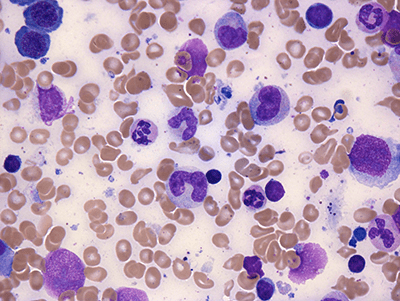Innere medizin i (onkologie, hämatologie, infektiologie). Zytopathologie & Knochenmarkpathologie - Schwerpunkte