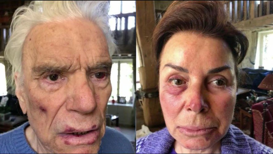 Son agresseur condamné · « ce sont des . Bernard Tapie Les Photos Choc De L Agression Actualites News Et Infos En France Et Dans Le Monde