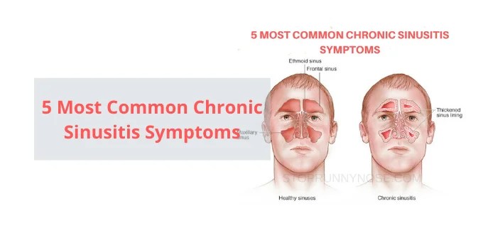 How To Get Rid Of A Sinus Infection Home Remedies And Medication