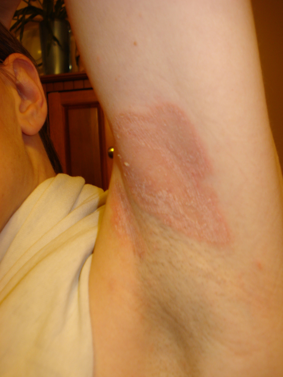 Its main cause is a fungi, . Rash Of Unknown Origin The Woo Woo Teacup Journal