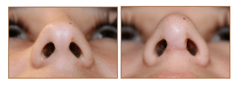 The bulbous nasal tip is a term used to describe when the nasal tip is excessively full or heavy. Rhinoplasty Nose Job Picture Gallery | Advanced Faces