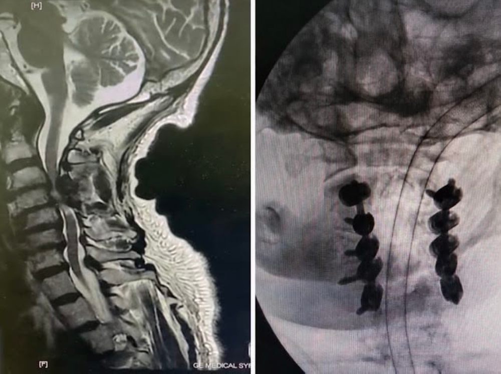 5 ساعات.. الملك سلمان الطبية تنهي شللًا رباعيًا لسبعيني 5 ساعات.. الملك سلمان الطبية تنهي شللًا رباعيًا لسبعيني