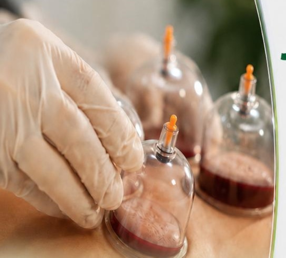 الوطني للطب البديل: الأدلة العلمية على الحجامة والوخز بالإبر لعلاج الصدفية ما تزال محدودة