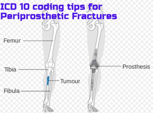 How to code Periprosthetic fractures in ICD 10 coding