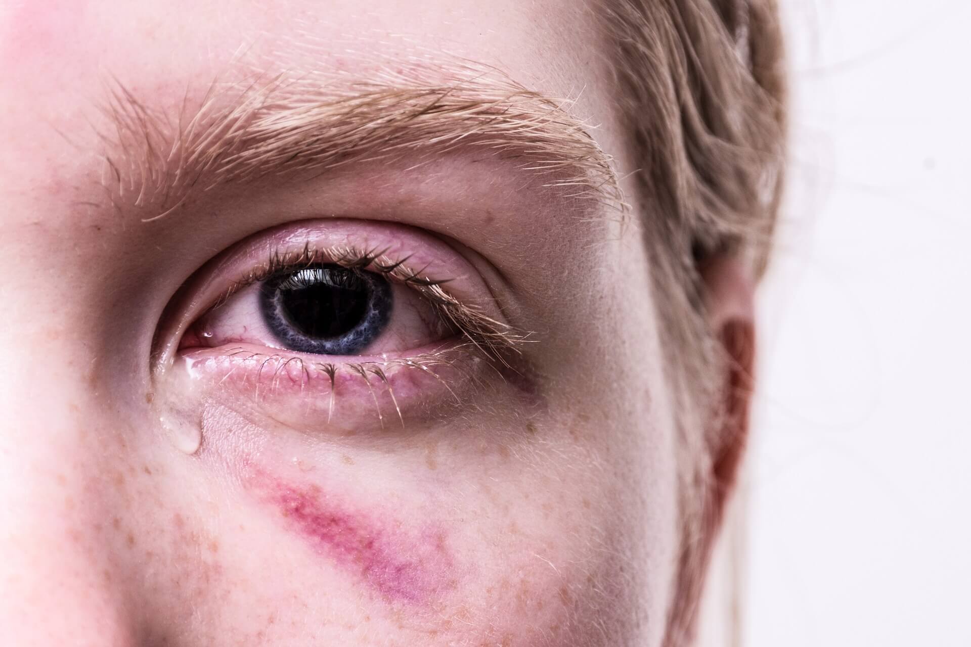 photo Geschwollene Tränensäcke Ursache aumedo