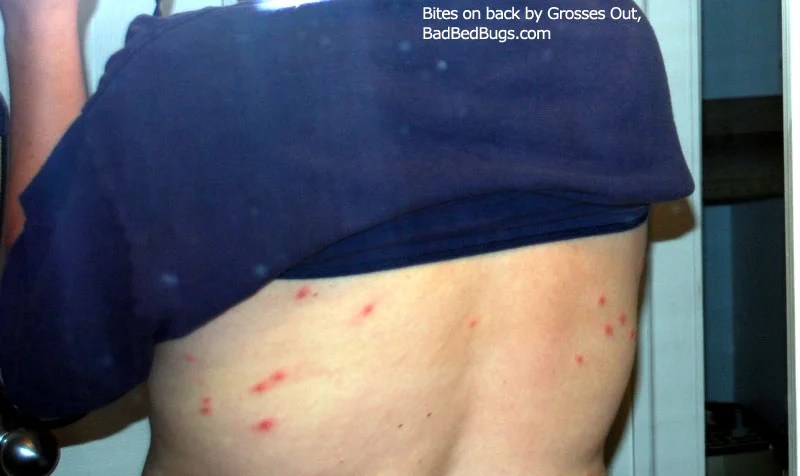 Dc photo/ getty images bed bugs were once a pest of the past, but they've made a remarkable. Bedbugs Bites: Discussion Pg 4