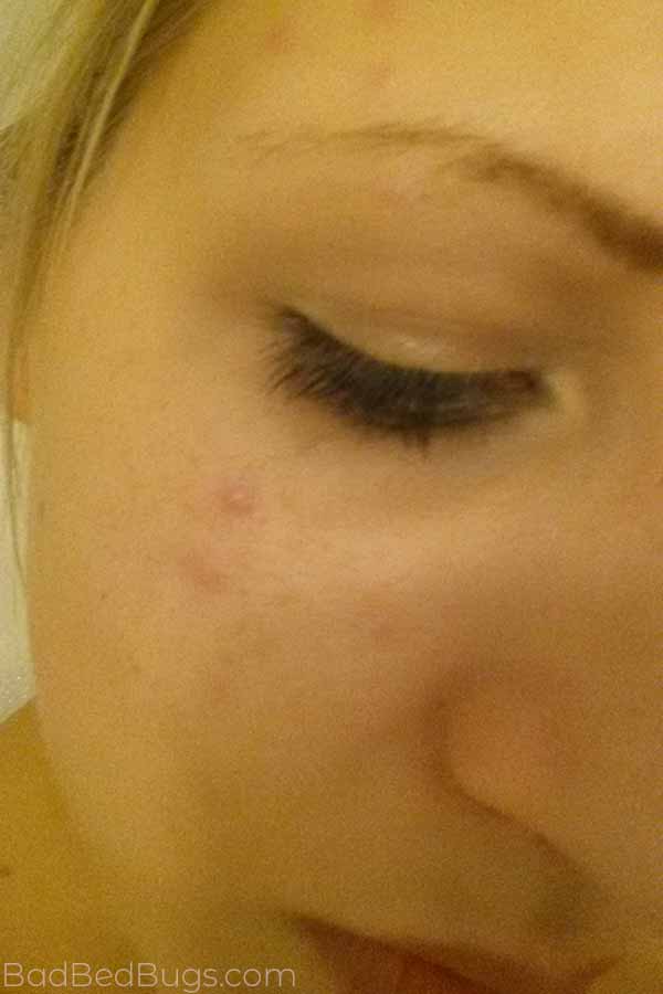 Bed bugs are tiny insects found inside of homes, offices and hotels that can bite people. What Do Bed Bug Bites Look Like