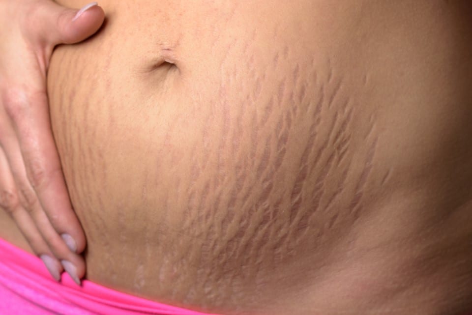 microdermabrasion for stretch marks