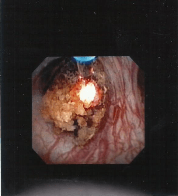 Le foglie carnose dell'aloe sono utilizzate per arricchire bevande e anche alimenti, come snack e pasta, oltre a specifici integratori e . Quali sono i sintomi dei calcoli renali ? - www
