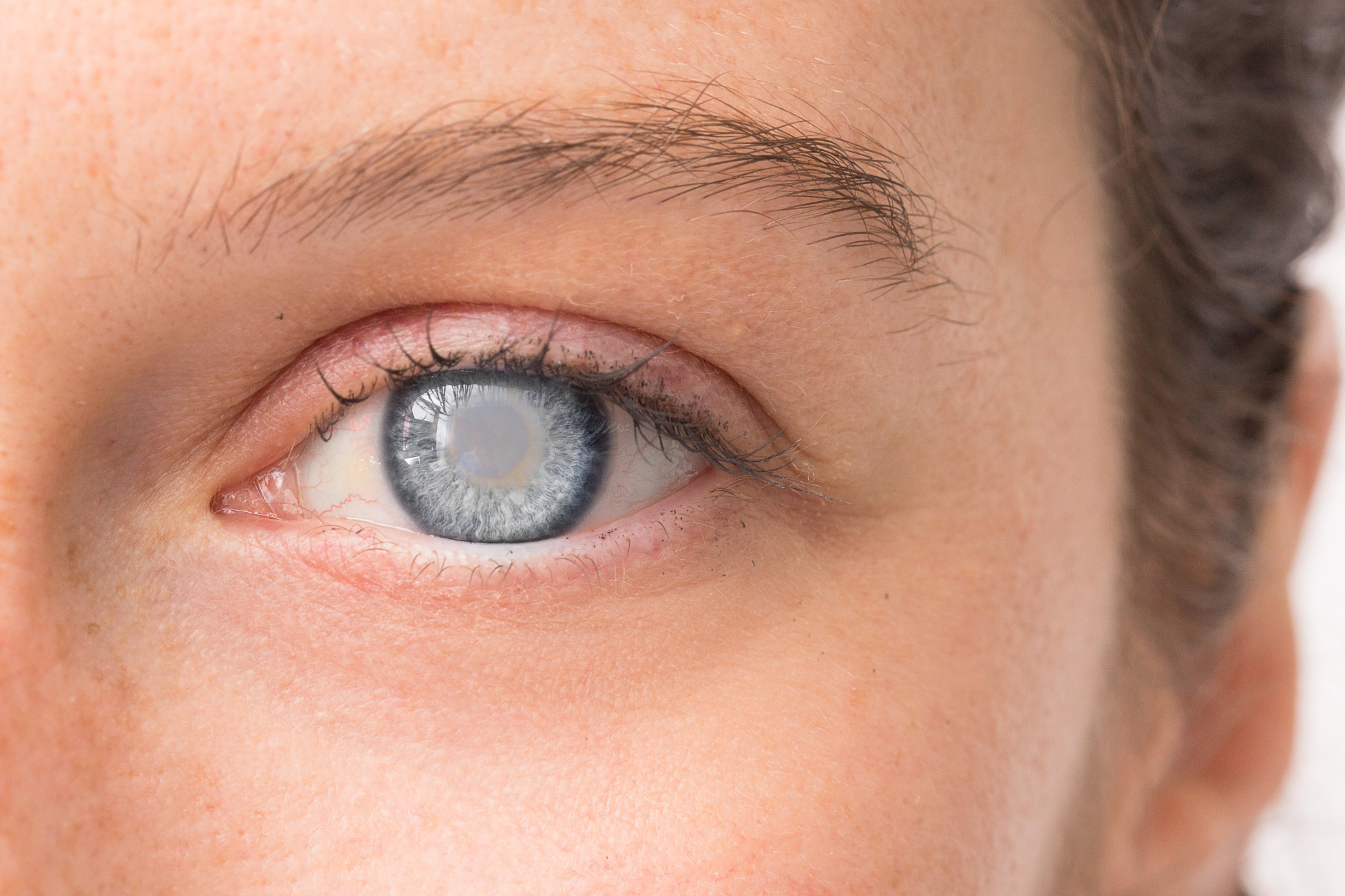 You can go blind from lasik. The 3 Most Common Types of Cataracts | Drs. Campbell