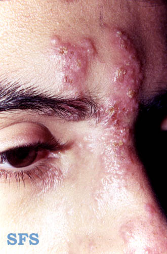 Nasal vestibulitis is also known as folliculitis. Chiropractic shingles provides alternative complementary