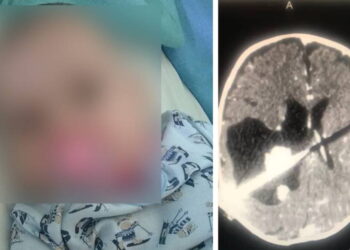 “No hay neurocirujanos ni anestesistas”: padres de bebé con tumor en la cabeza ruegan por operación para su hija