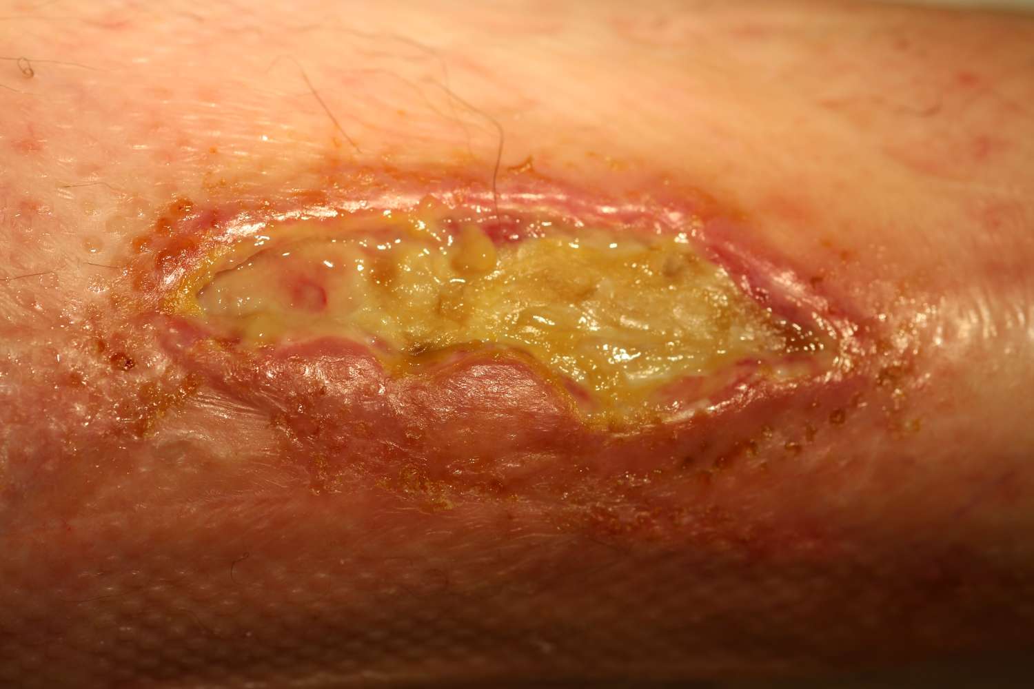 Oral medications (pills) for diabetes diabetes pills don't work for everyone. Skin Ulcers - safe & effective help from an expert
