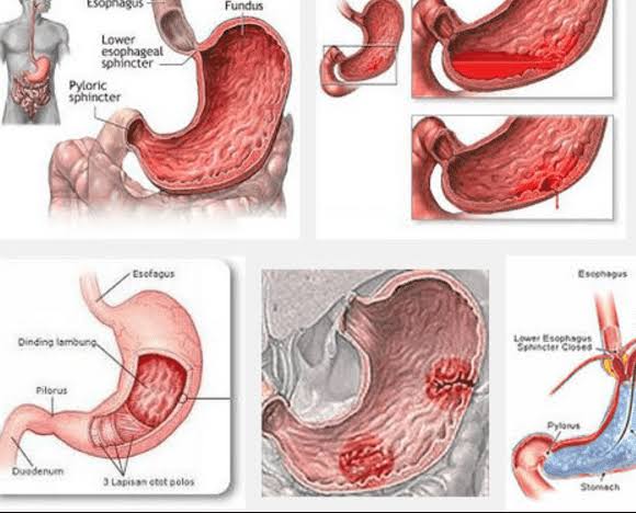 Asam Lambung Dapat Memicu Pendarahan Pada lambung Yang Bisa Berujung  Kematian - Dodoku GMIM