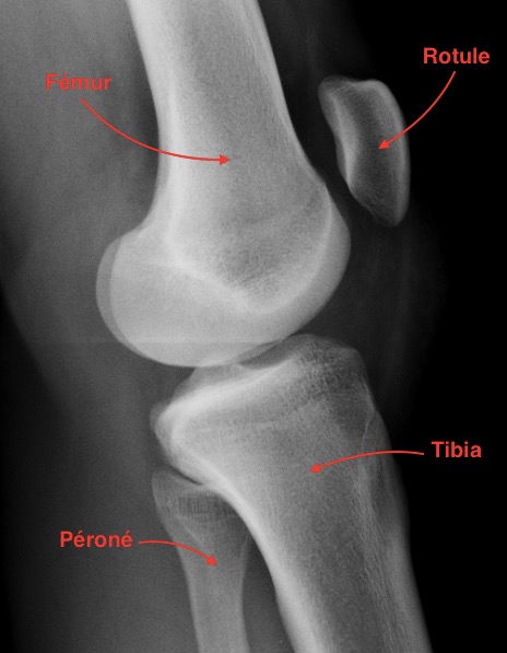 Arthrose du genou (gonarthrose) - Dr SIMIAN, Périgueux