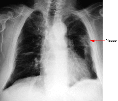 Amiante : pas de panique &hellip; - Pourquoi Comment Combien