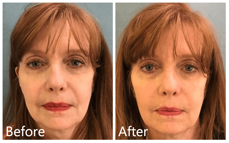 Sep 19, 2018 · after having just having 10 nova threads jowls midface can i add s filler to my face, not allot face looks thin, i have always used filler last ten years never used threads before, but the fill for me personally seems to dissipate faster than usual, and it’s more expensive than the threads but it gives me more youthful look. Facial Fillers Manhattan Dermal Fillers New York City
