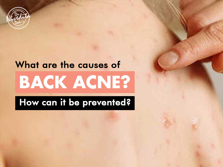 Are acrylic nails bad for my health? What are the Causes of Back Acne? How can it be Prevented?