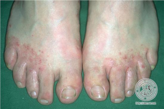 This skin condition is common under the breasts, inthe groin area, and under the tummy . Print Scaling Lesions flashcards | Easy Notecards