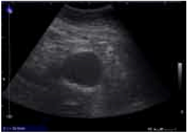 Abdominal Aortic Aneurysm: Clinical Highlights/Updates - emdocs
