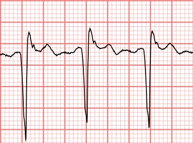 Subtle ECG Findings in ACS: Part III Benign Early Repolarization vs ...