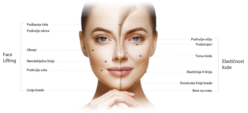 Hifu Renew Lift Ordinacija Dentalne Medicine