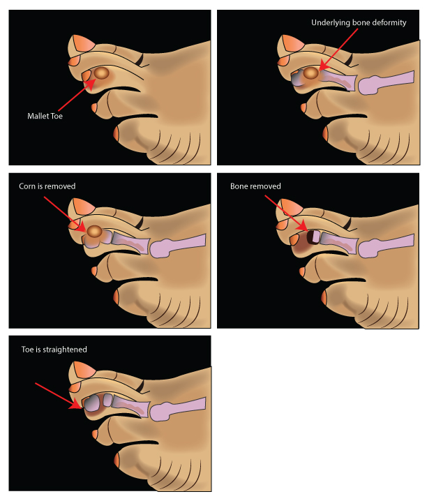 Your bone or foot doctor will recommend the kind that will work best for you. More Hammertoe Surgical Procedues