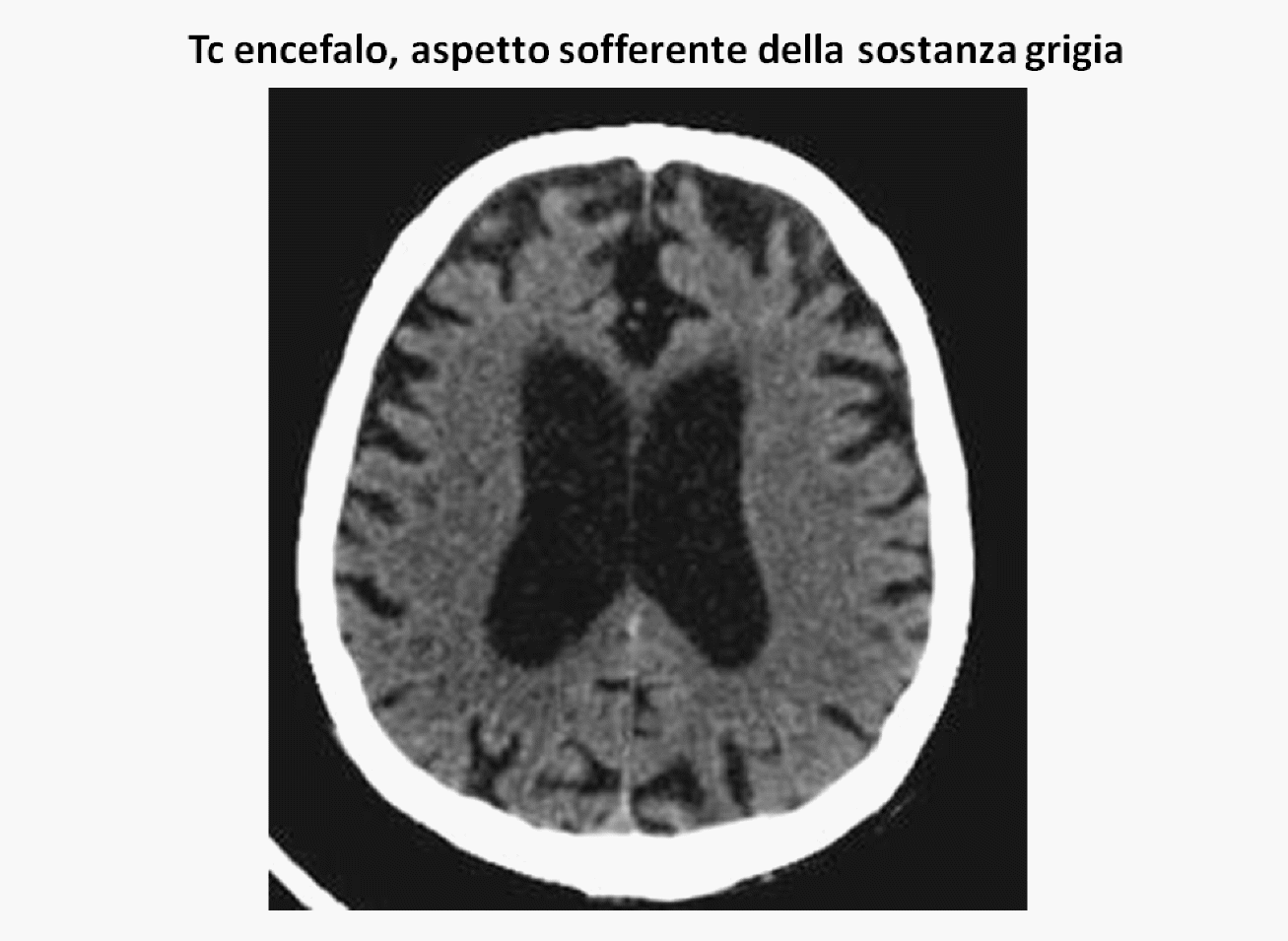 Demenza Multinfartuale
