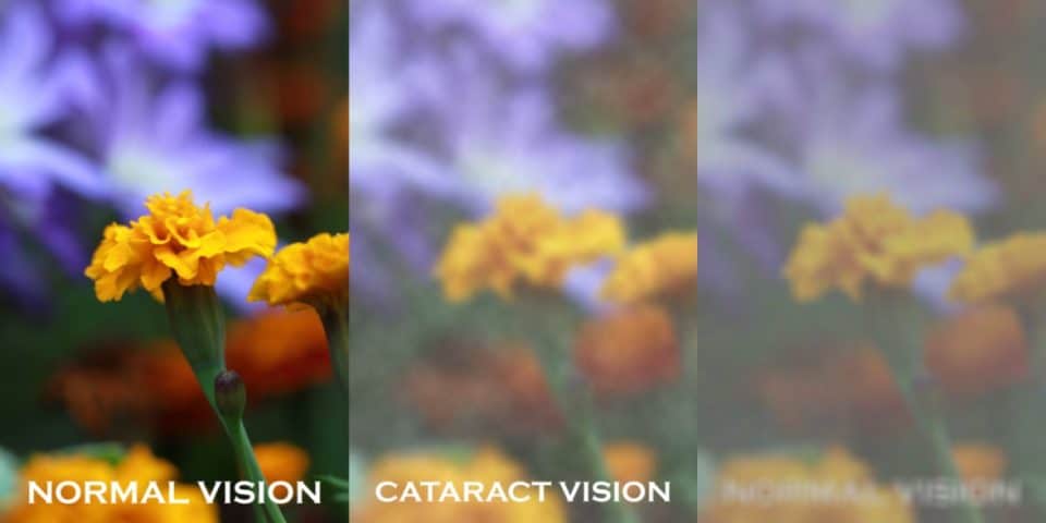 But the last few years have brought changes to how some common lab tests are done. Cataracts: What to expect & how to slow it down