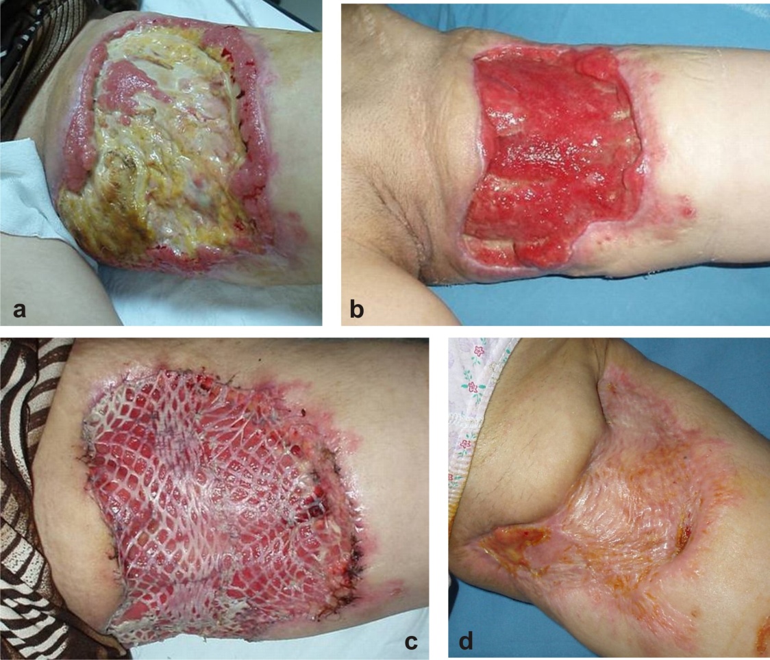 photo Skin Grafts Meaning intechopen