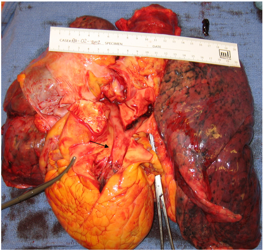 Embolization of a deep venous thrombosis to the main pulmonary arteries (saddle embolus) resulting in critical loss of oxygen flow to the . Contemporary Surgical Management of Acute Massive