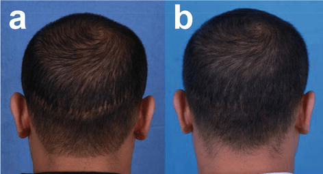 Saat mengidap penyakit alopecia, penderita mungkin . Cicatricial Alopecia Intechopen