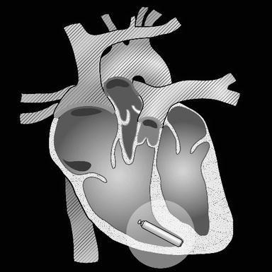 A battery that typically lasts between 8 and 13 years.3,4. Leadless Pacemakers Intechopen