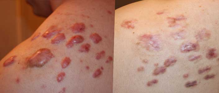 Laser therapy this treatment uses high . Keloid Specialist, Keloid Removal Expert, Keloid Treatment