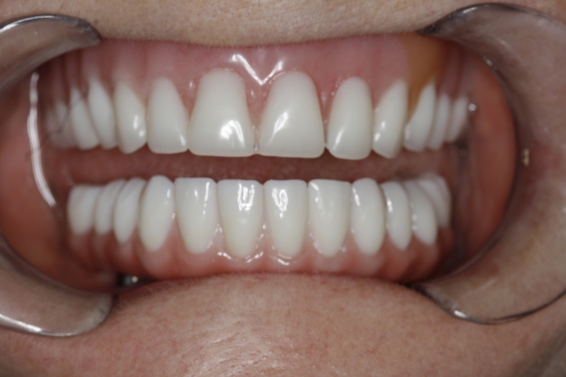 Can Dentures Fix An Underbite  : When You Visit 209 Nyc Dental, We Will Help You Assess Your Smile Carefully To Determine The Cause And Severity Of Your Invisalign For Underbite.