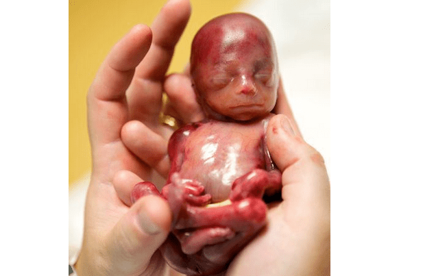I fell pregnant very fast which was a shock (this was my first ever pregnancy) but. What does miscarriage look like at 6 weeks? Family Remembers Baby Walter, Who Miscarried at 19 Weeks