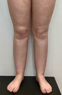 Im „günstigsten“ falle kommt man so auf gdb . LipÃ¶dem - Bindegewebecentrum