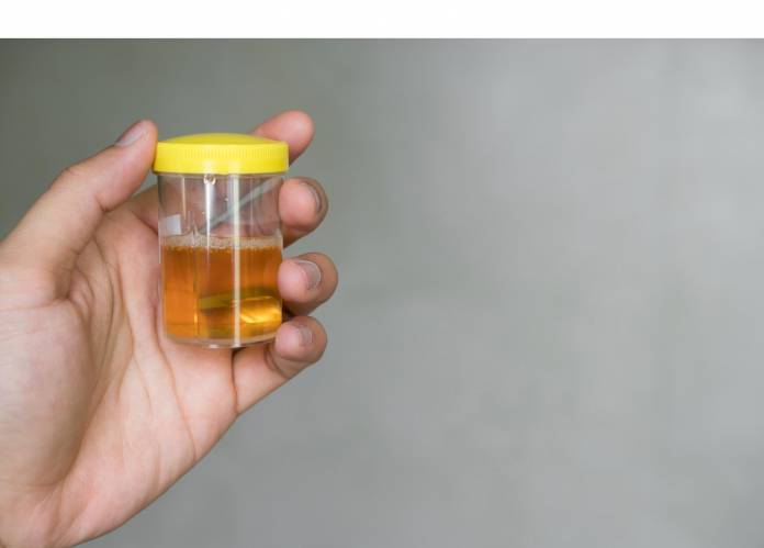 Beide haben mir ihre angebote per nachricht geschickt und ich habe auch akzeptiert, indem ich mit ja antwortete. Dunkler Urin Â» Ursachen, Diagnose, Behandlungen