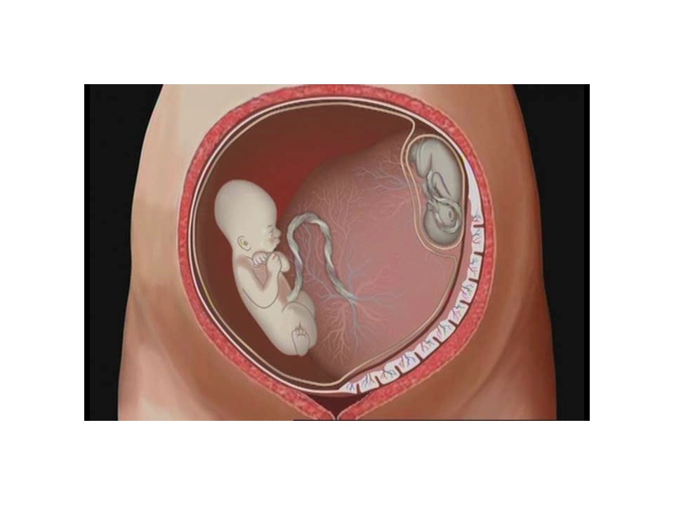Not what you were looking for? Information On Ttts Multiple Pregnancy Registry