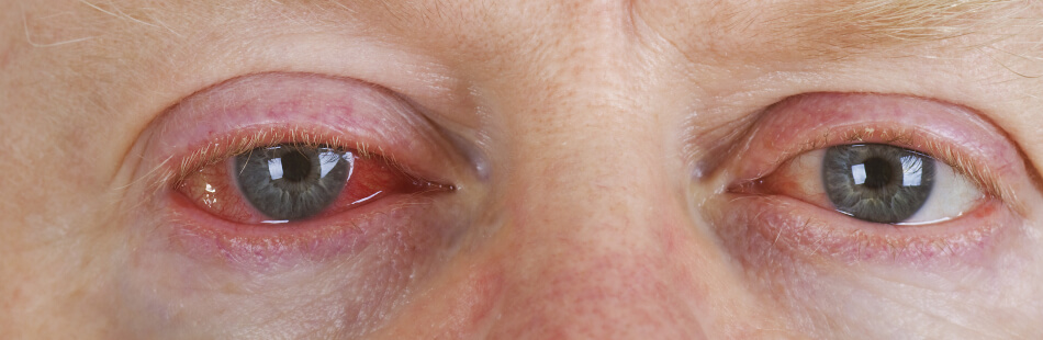 Mooci Bindehautentzundung Konjunktivitis