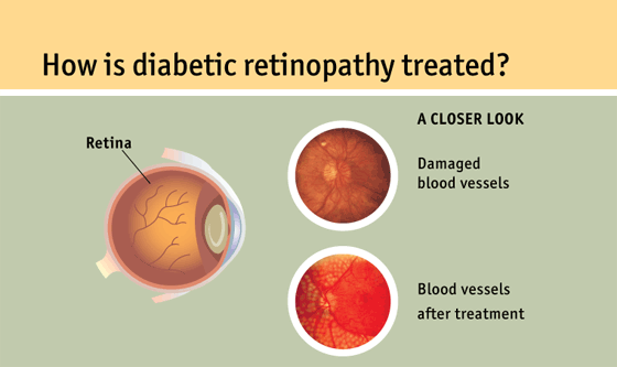 Diabetic retinopathy is a complication of diabetes that causes damage to the blood vessels in the retina. Diabetic Eye Disease: A Self-Guided Module