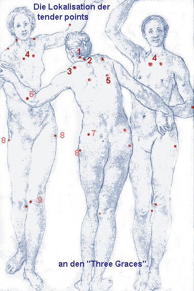 Solche symptome können auf eine fibromyalgie hinweisen. Fibromyalgie