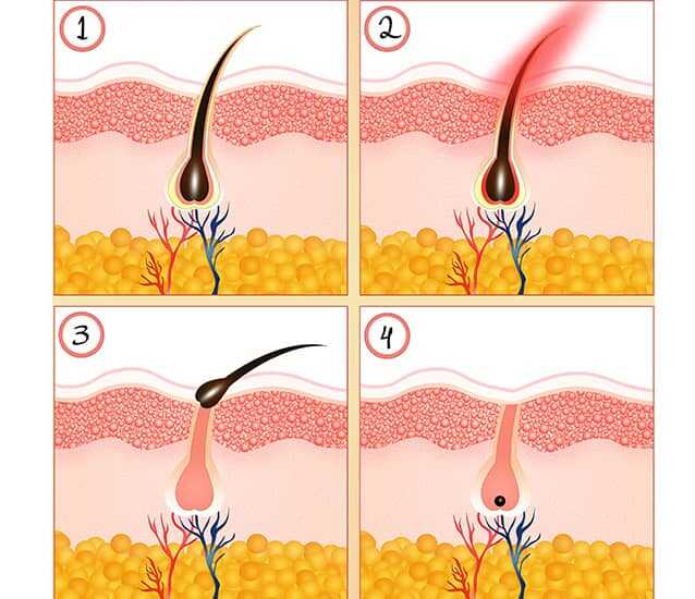 Body hair can be annoying if it’s growing where it’s unwanted. 9 Important Differences Between Ipl And Laser Hair Removal User Info