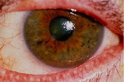 Novita Per La Diagnosi Dell Occhio Secco Studio Oculistico Orione