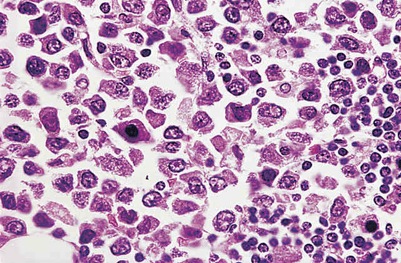 Richter’s transformation – prolymphocytes, large cells, or what? | Pathology Student