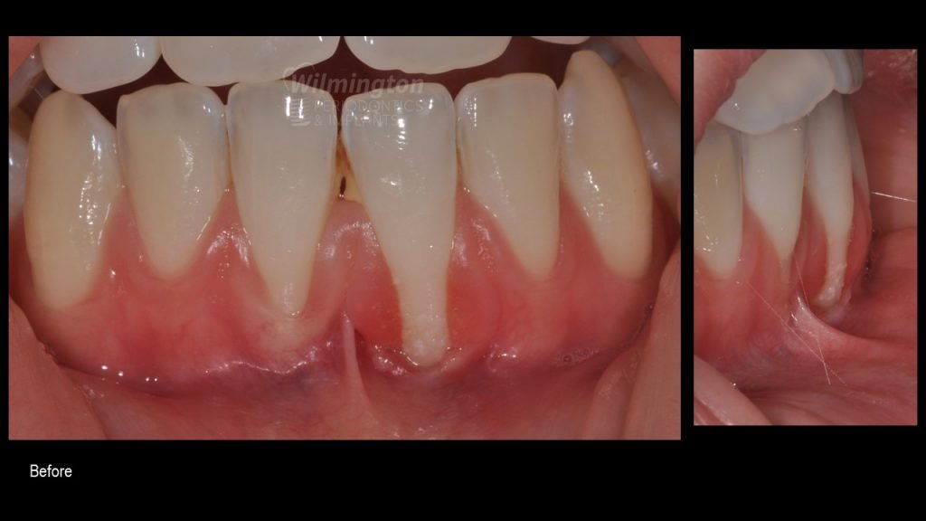pix Receding Gums Before And After Treatment wilmington periodontics