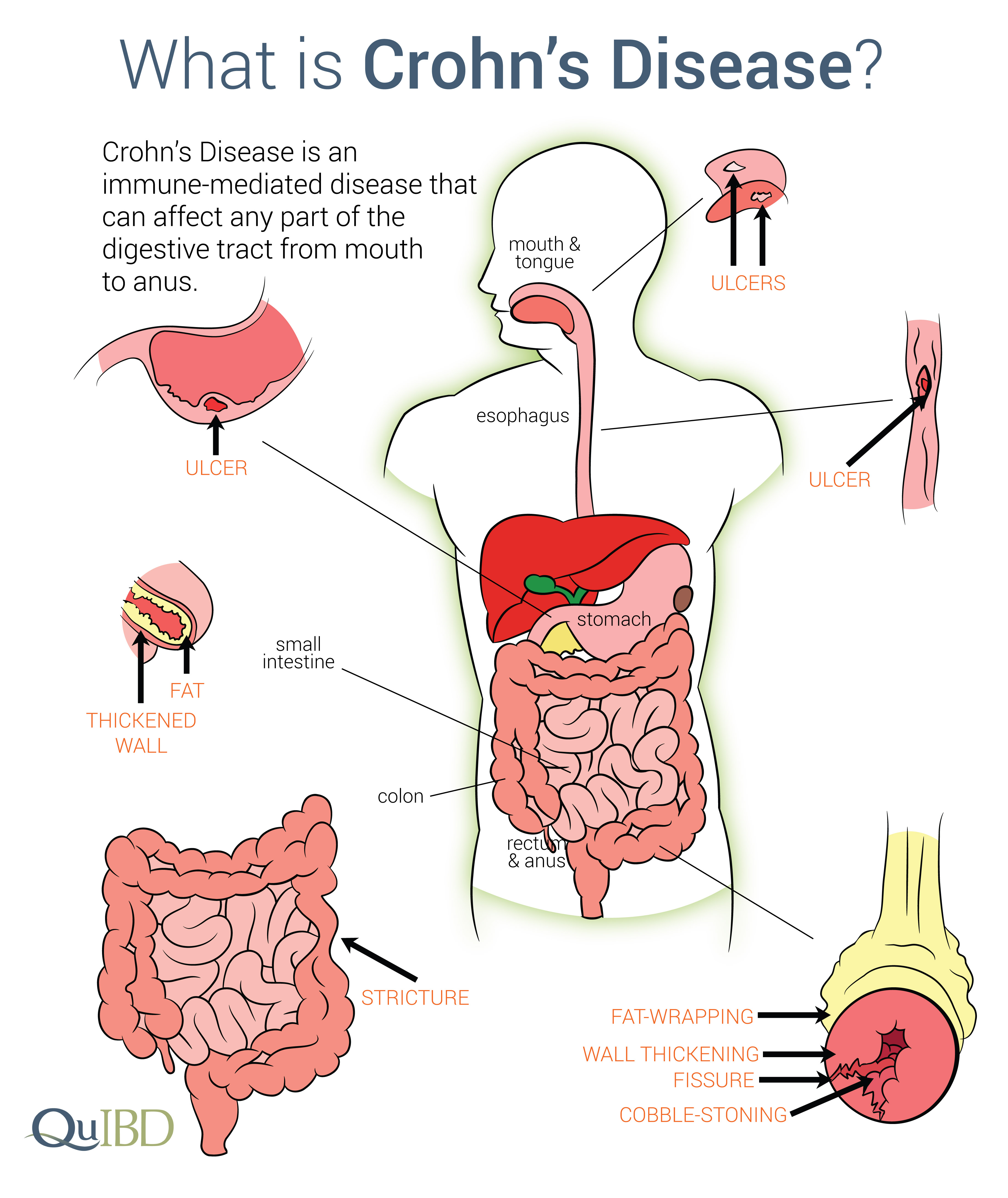 The study also involved patients with … Crohn S Disease Ibd Symptoms Advances Impact Causes