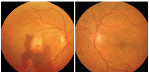 They happen the same way other strokes do, by a blockage of blood flow. Lesson: Explanations for Sudden Vision Loss